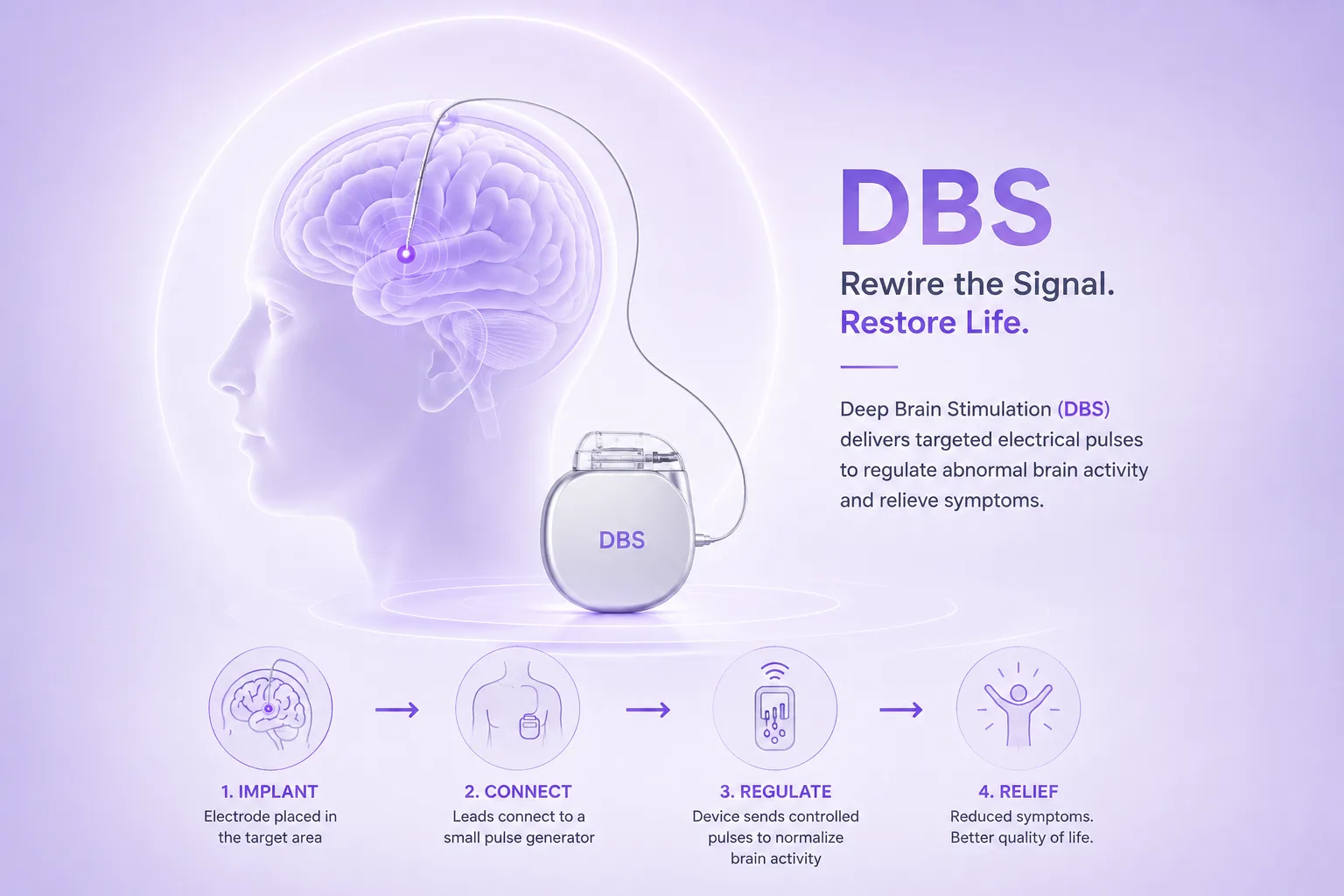 Deep Brain Stimulation (DBS) infographic illustrating brain electrode placement, implanted pulse generator, electrical stimulation, and symptom relief for neurological disorders