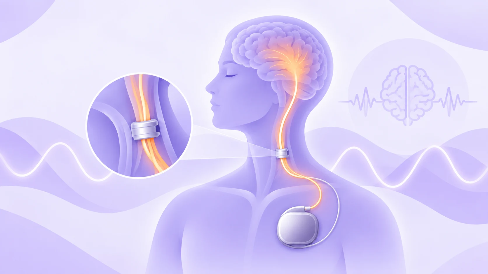 Vagus nerve stimulation (VNS) therapy for drug-resistant epilepsy, showing the implanted vagus nerve stimulator and key treatment benefits.